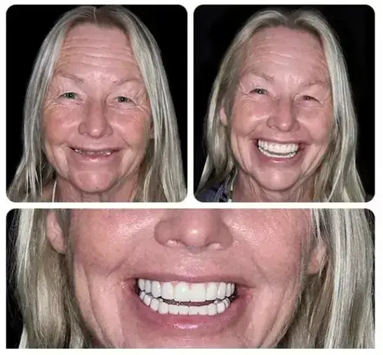 【Official Brand -Custom-Fit Functional Dentures — Combination pack - Image 3