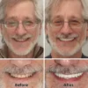 –Advanced Custom-Fit Functional Dentures