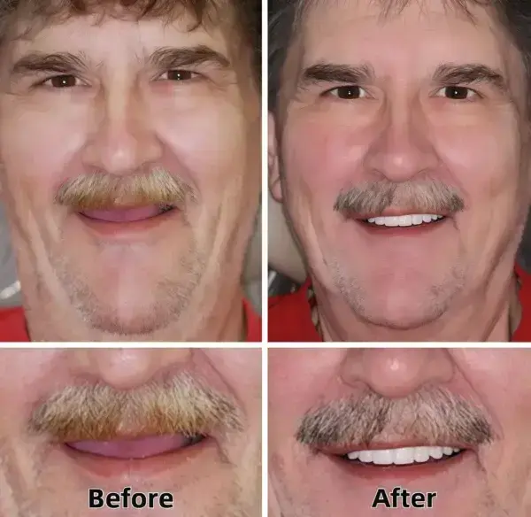 –Advanced Custom-Fit Functional Dentures - Image 6