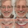 –Advanced Custom-Fit Functional Dentures