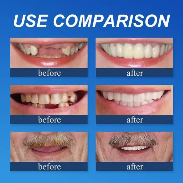Premium Dentures - Image 5